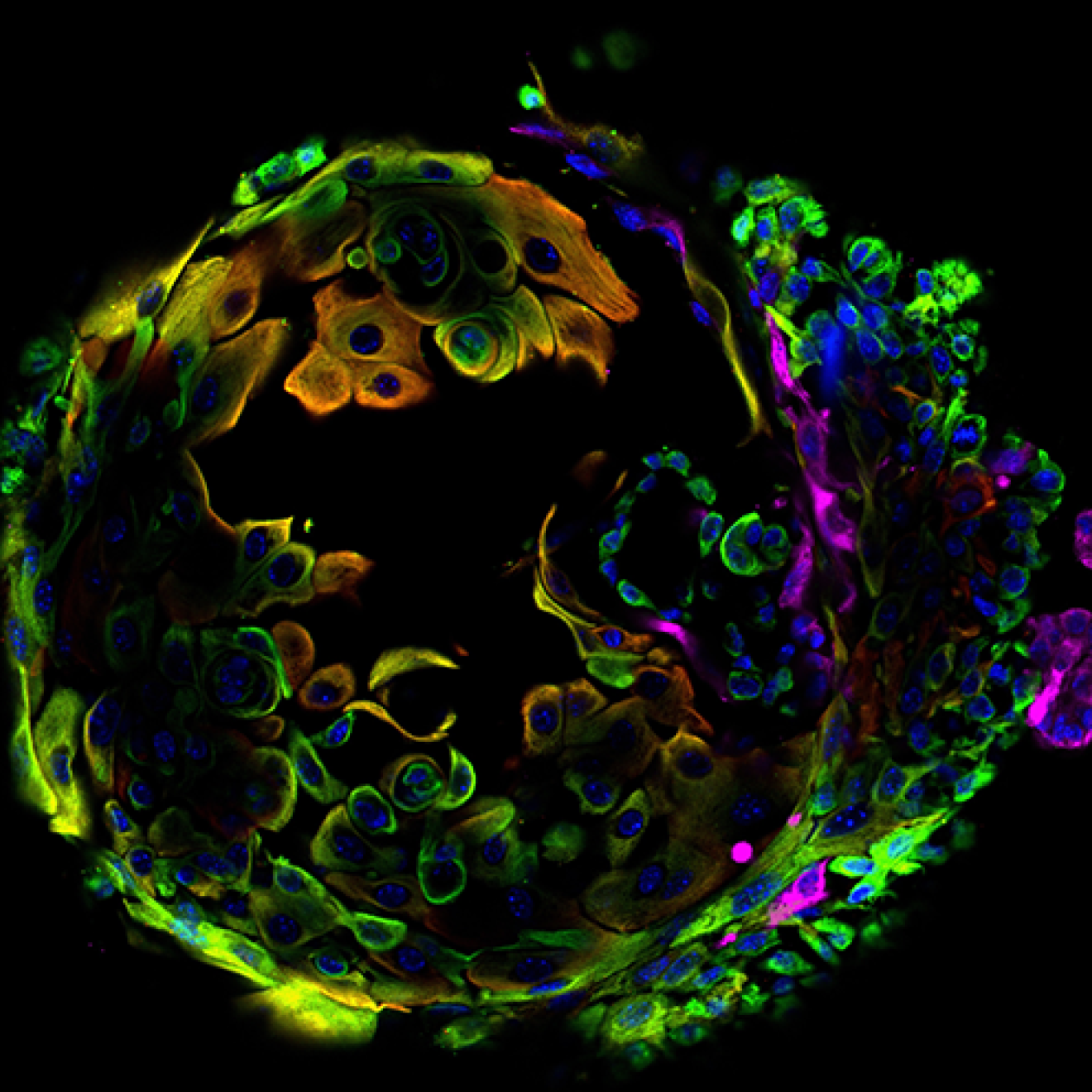 Colorful microscopy showing a breast cancer cell against a dark background